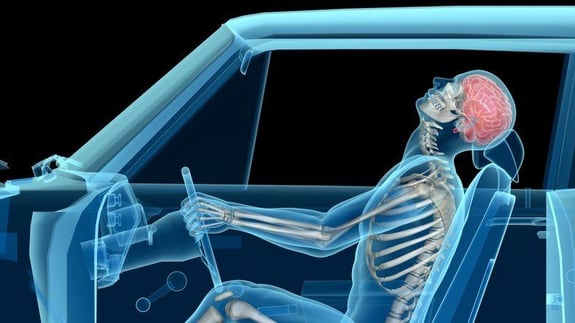 Effects of whiplash in a car accident